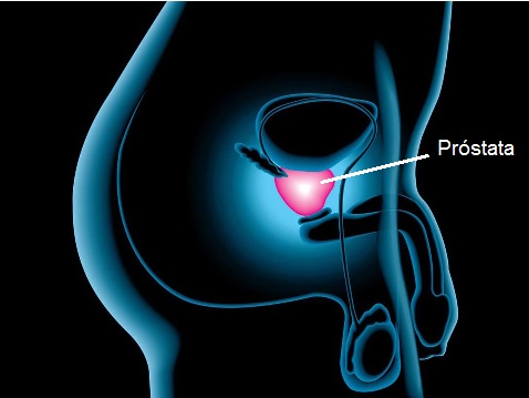 cáncer próstata